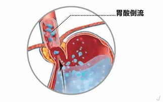 胎儿长头发会导致孕妇烧心吗视频