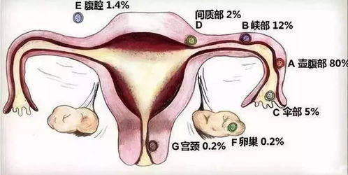 两次宫外孕以后还能正常怀孕吗