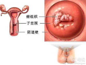 宫颈囊肿是怎么回事严重吗