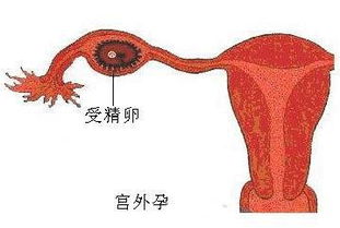 宫外孕腹腔手术多久完全恢复