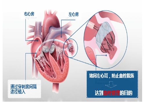 八岁女孩先天心脏房间缺损微创手术费用要多少钱