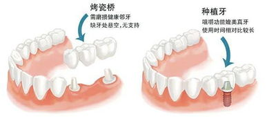 固定假牙可以用多久