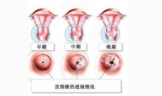 女性hpv高危阳性到底能不能治好