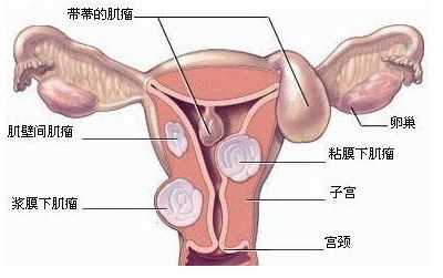 怀孕胆结石会有影响吗