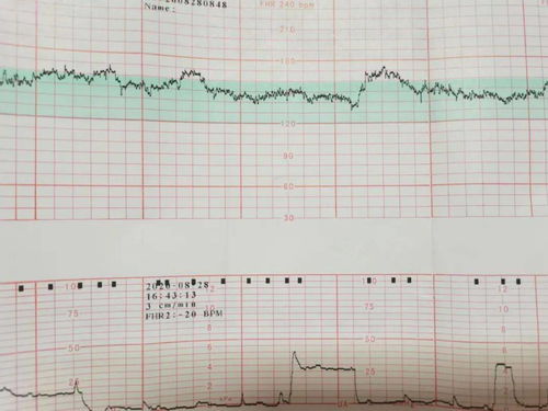 胎儿胎心每分钟160正常吗