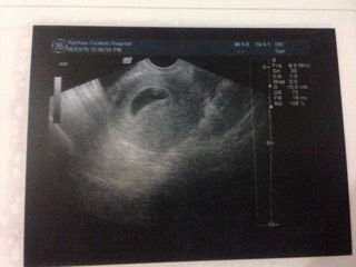 孕囊是3.7×3.8×4.8是长行还是圆形