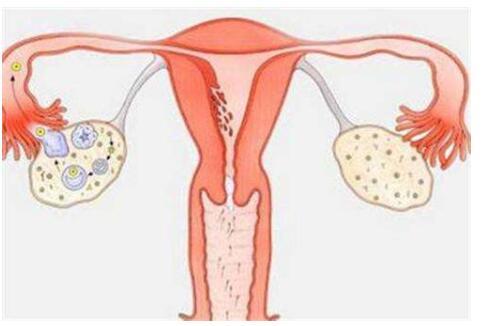 多囊卵巢综合症很可怕吗