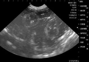 孕期b超检查怎样进行的