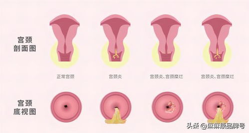 女人太懒会得盆腔炎吗