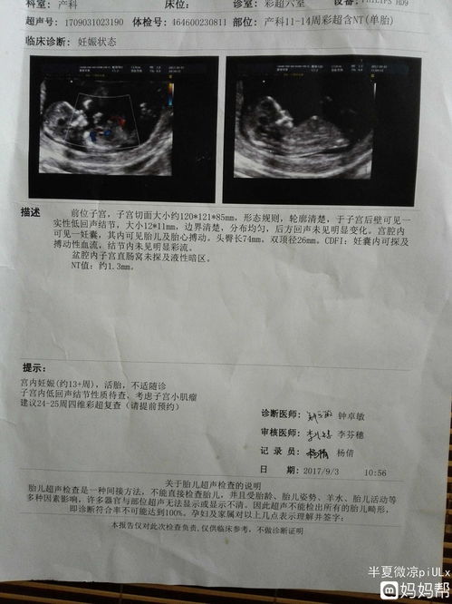 早期唐筛和nt都过了 免费的中期唐筛没过