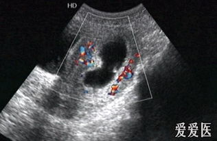 hcg多少可以看到卵黄囊