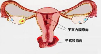 女性宫颈肥大需要治疗吗