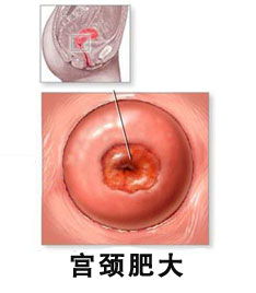 女性宫颈肥大需要治疗吗