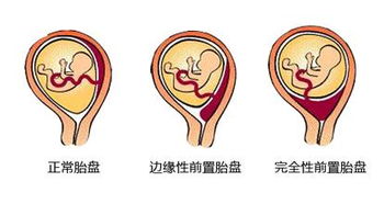 胎盘钙化b超如何描述