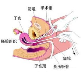 药流一定要清宫吗要根据情况而定