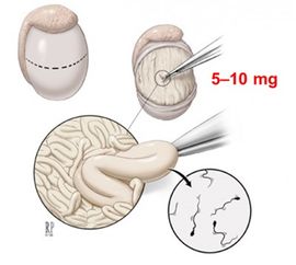 先天性的无精症可以显微镜取精吗