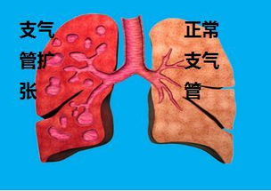 治慢性支气管炎的偏方