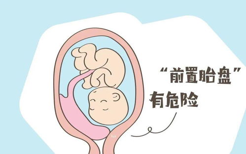 子宫和胎盘粘连是怎么回事