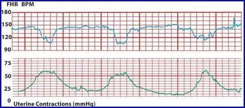 什么是胎心监护带