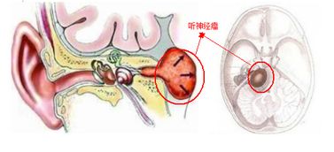 卵巢囊肿手术后还会复发吗