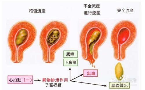 女性宫寒会导致不孕吗