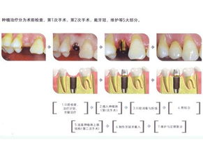 温州种植牙的过程是怎样的？