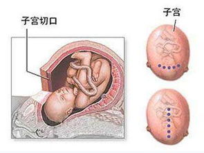 引产有哪些危害和后遗症