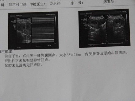 不规则妊娠囊，孕囊内未见胚芽及卵黄囊