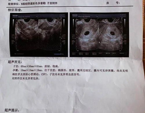 59天，小B超归来！！帮我看看胎囊是长的还是圆的哇？