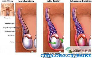 如何判断自己睾丸扭转