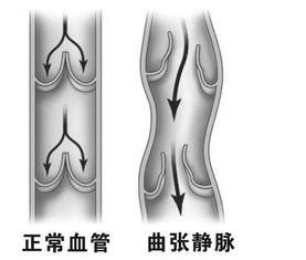 出现了静脉曲张该怎么办呢