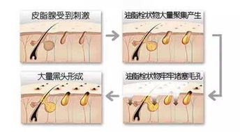 怎么去除重度的黑头