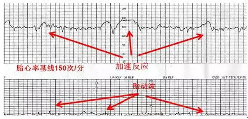 胎心率161次/分正常吗？