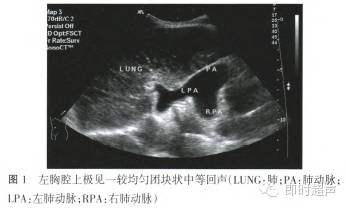 胎儿隔离肺的超声表现