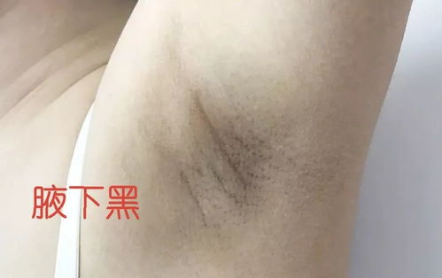 孕妇腋下出汗多怎么办妙招