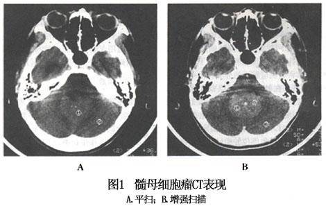 空孕囊最长能存活多久自然排掉