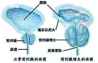 男性患上前列腺炎有什么表现