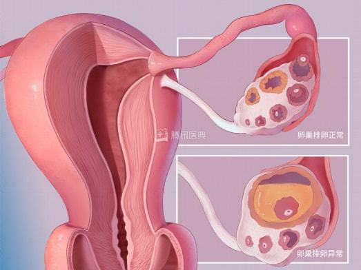 怀孕后出现黄体囊肿需要治疗吗