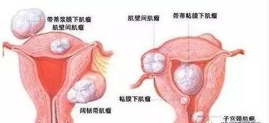 怎么样知道自己是不是宫寒呢