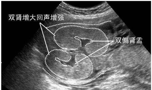 孕24周四维彩超上双肾未见分离是什么意思