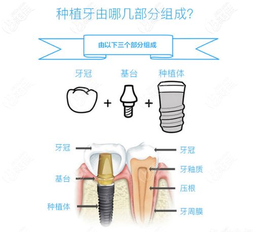 种植牙的牙冠脱落了怎么办