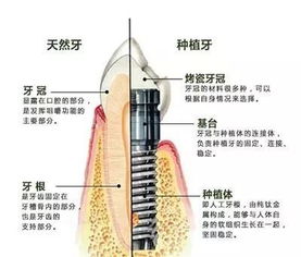 种植牙的牙冠脱落了怎么办