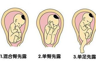 羊水胎盘和胎儿共多重