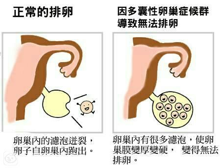 多囊卵巢综合症患者如何备孕