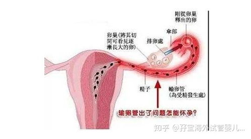 盆腔积液治好了可以怀孕吗