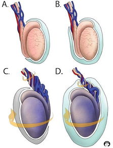 附睾炎会导致睾丸扭转吗