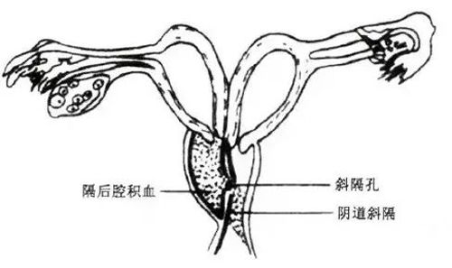 子宫膜闭锁正确处理