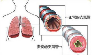 气管炎怎样调理