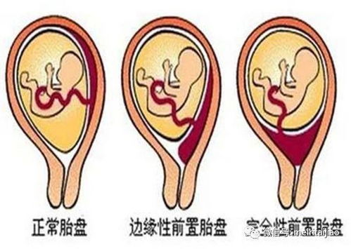 胎盘前壁和前置胎盘一样吗?