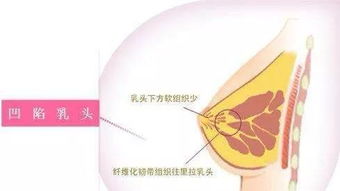 催乳素偏高要注意什么？